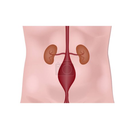 Illustration for Aneurysm of the abdominal aorta. Diagram with kidneys on the background of the torso. Medical poster. Vector illustration - Royalty Free Image