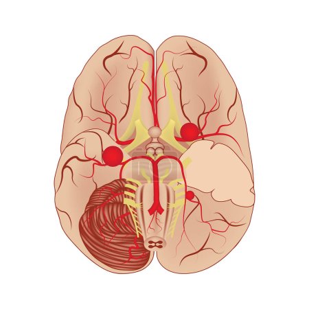 Aneurismas cerebrales, vista ventral. Cartel médico. Ilustración vectorial
