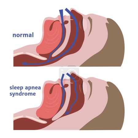 Ilustración de Apnea del sueño. Diagrama de vías respiratorias. Cartel médico. Ilustración vectorial - Imagen libre de derechos