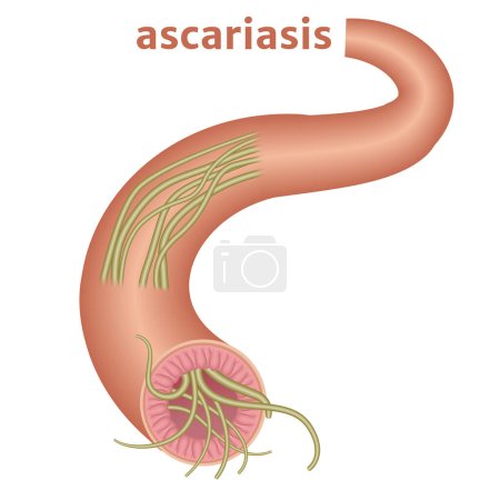 Ilustración de Ascariasis. Parásitos en el intestino delgado. Infección corporal. Ilustración vectorial - Imagen libre de derechos