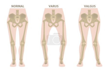 Deformidades en las piernas de Valgus y Varus. Diagrama que muestra los huesos deformados de las extremidades inferiores. Patología cosmética. Ilustración vectorial.
