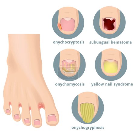 Ilustración de Tipos de daño en las uñas de los pies. Pie con hongo. Cartel médico. Ilustración vectorial - Imagen libre de derechos