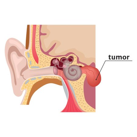 Téléchargez les illustrations : Schwannome vestibulaire. Diagramme avec une tumeur à l'oreille interne. Illustration vectorielle - en licence libre de droit