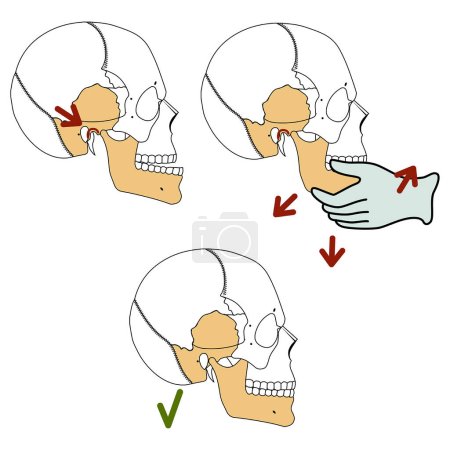 Reducción de la articulación temporomandibular. Ilustración vectorial