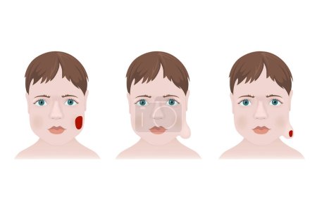 Illustration for Types of hemangiomas on the face of a child. Medical poster vector illustration - Royalty Free Image