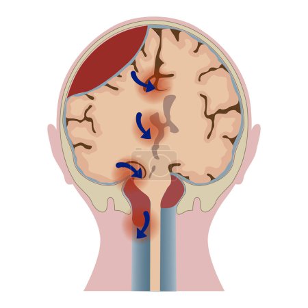 Téléchargez les illustrations : Hématome cérébral avec distorsion tissulaire. Tête sectionnée. Affiche médicale. Illustration vectorielle - en licence libre de droit