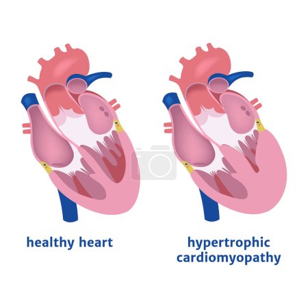 Hypertrophic cardiomyopathy. Expansion of the ventricle of the heart. Medical poster vector illustration