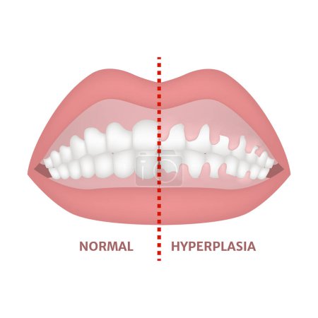 Gingival hyperplasia. Medical poster. Vector illustration