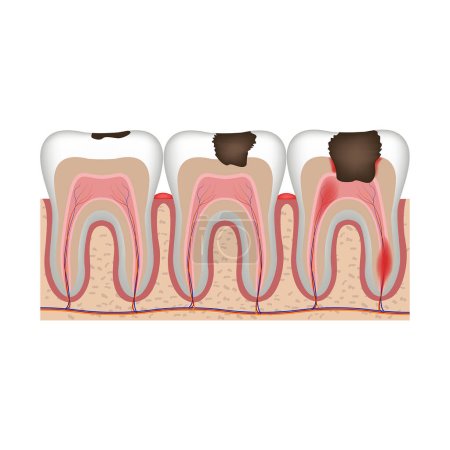 Karies-Stadien. Stadien der Zahnzerstörung und der Zellstoffentzündung. Anschauliches Vektordiagramm