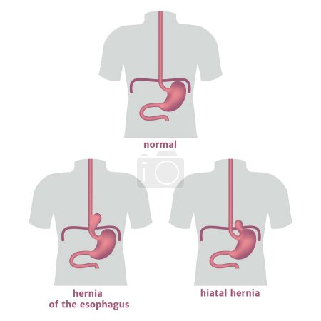 Torso with hernia of the stomach and esophagus. Medical poster. Vector illustration