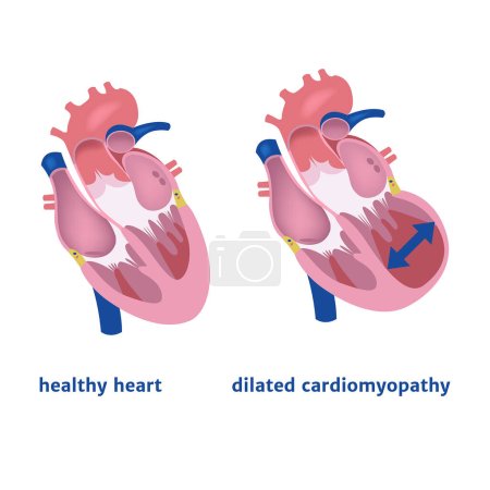 miocardiopatía dilatada. Expansión del ventrículo del corazón. Cartel médico vector ilustración