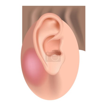 Ilustración de Mastoiditis. Enfermedad inflamatoria del oído. Cartel médico vector ilustración - Imagen libre de derechos