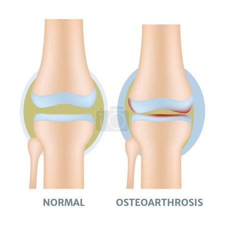 Ilustración de Rodillas con osteoparosis. Ilustración plana del vector - Imagen libre de derechos