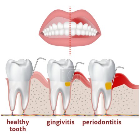 periodontitis y gingivitis. Diagrama con enfermedad de dientes y encías. Cartel médico vector ilustración