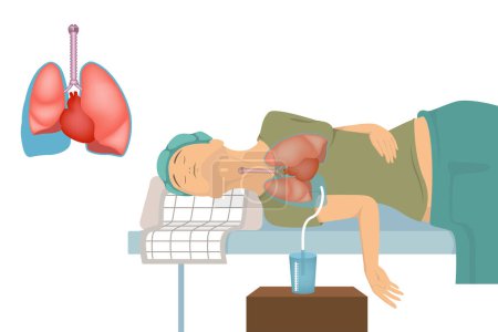 Illustration for Pleural effusion. Patient with a catheter in the lungs. Procedure with pumping out excess fluid. Vector illustration - Royalty Free Image