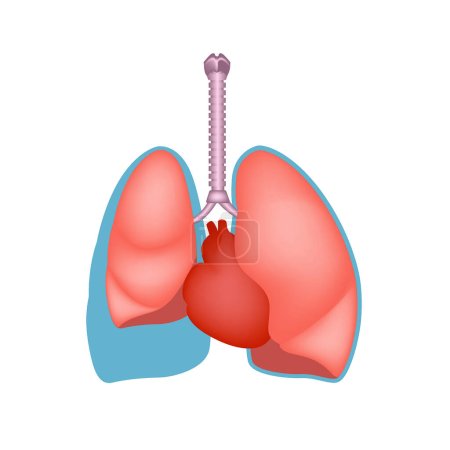 Illustration for Pleural effusion. Excess fluid in the lungs. Medical poster. Vector illustration - Royalty Free Image