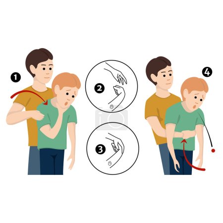 Illustration for Heimlich's maneuver. First aid procedure for choking due to obstruction of the upper respiratory tract by foreign bodies. Vector flat illustration - Royalty Free Image