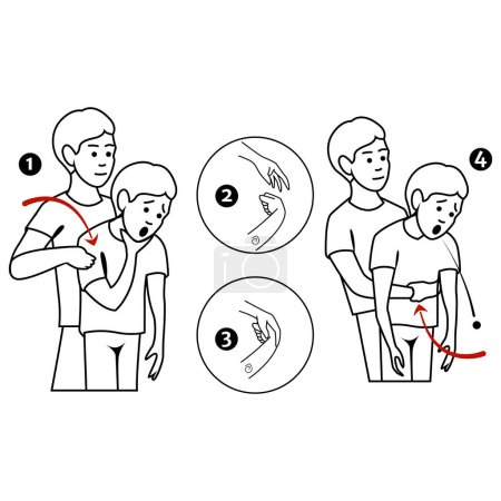 Illustration for Heimlich's maneuver. First aid procedure for choking due to obstruction of the upper respiratory tract by foreign bodies. Vector flat illustration - Royalty Free Image