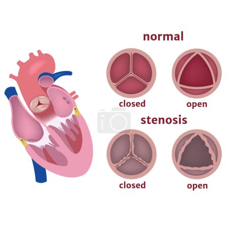 Téléchargez les illustrations : Sténose de la valve aortique du cœur. Infographie des maladies. Illustration vectorielle - en licence libre de droit