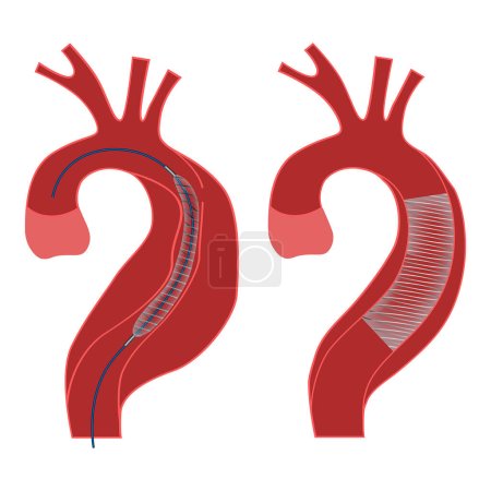 anévrisme aortique. Une endoprothèse aortique. Schéma avec étapes. Affiche médicale. Illustration vectorielle