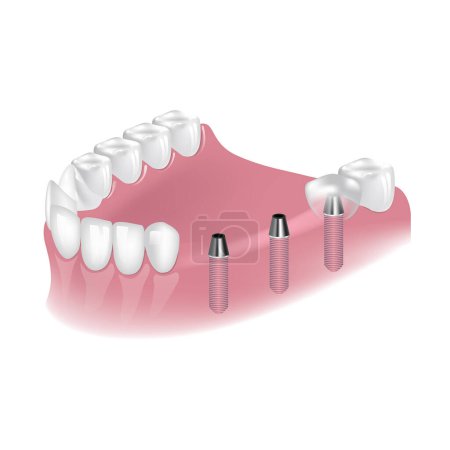 Téléchargez les illustrations : Placement d'implants pour la reconstruction des dents sur la mâchoire inférieure. Chirurgie dentaire pour le placement de poteaux métalliques. Illustration vectorielle - en licence libre de droit