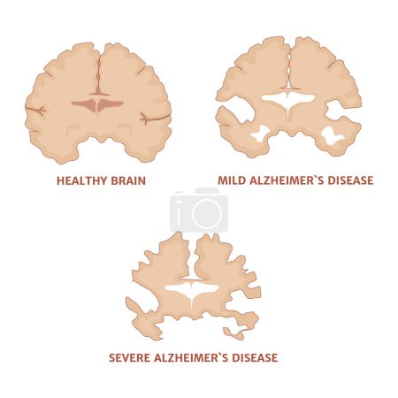 Ilustración de La enfermedad de Alzheimer. Etapas de desarrollo de la patología con indicación del hipocampo afectado. Cartel médico. Ilustración vectorial - Imagen libre de derechos