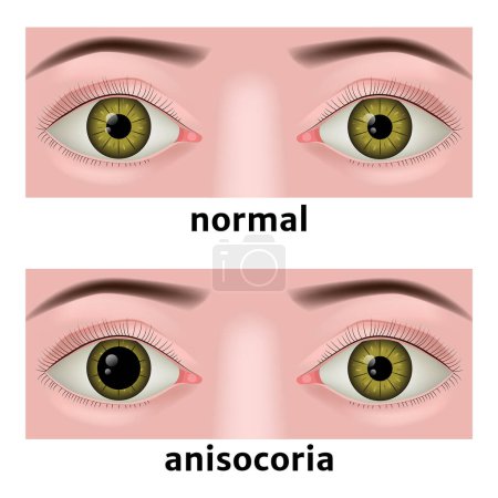 Ilustración de Anisocoria. pupila anormalmente dilatada del ojo. Enfermedades oftálmicas. Cartel médico. ilustración preliminar - Imagen libre de derechos