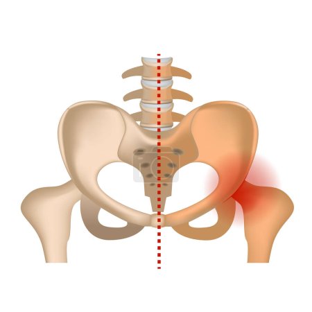 aseptic necrosis. Hip bone with damaged femoral head. Infographic with axis of symmetry. Vector illustration