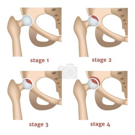 Illustration for Aseptic necrosis. Stages of destruction of the femoral head. Medical poster. Vector illustration - Royalty Free Image