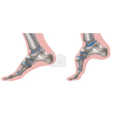 Charcot-Marie-Tooth disease. hereditary disease. Foot of a patient with characteristic symptoms. Hereditary motor-sensory neuropathy. Damage to motor and sensory peripheral nerve fibers.