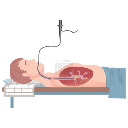 Illustration for Bronchoscopy. The patient is in the supine position. Medical examination. Vector flat illustration - Royalty Free Image