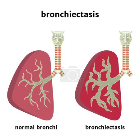 Bronquiectasias. Ampliación de la luz de la vía aérea. La inflamación de los bronquios. Cartel médico. Ilustración vectorial