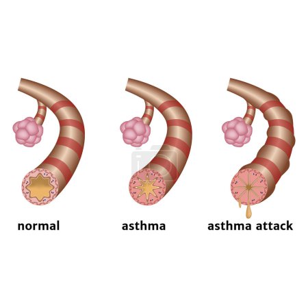 Bronchial asthma. Chronic inflammation of the lower respiratory tract. Suffocation attacks. non-atopic asthma. Medical infographic. Vector illustration