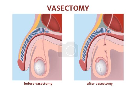 Illustration for Vasectomy. Prevention of unwanted pregnancy. Severed seminal ducts. Diagram with the anatomy of the male reproductive system. Medical poster. Vector illustration - Royalty Free Image