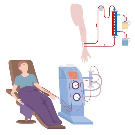 Der Patient auf dem Stuhl ist mit dem Hämodialysegerät verbunden. Extrarenale Blutreinigung. Medizinische Eingriffe. Vektorflache Illustration