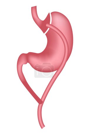 Gastric bypass. Treatment of obesity with surgery. Vector illustration