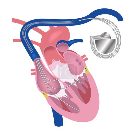 Pacemaker. Coeur en coupe longitudinale. Illustration médicale vectorielle