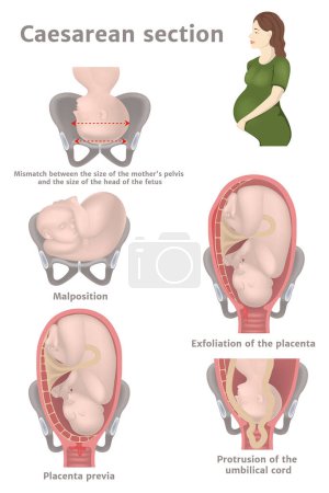 Illustration for Indications for caesarean section. Exfoliation of the placenta, incorrect position of the fetus, protrusion of the umbilical cord. Pregnant woman. Medical poster. Vector illustration - Royalty Free Image