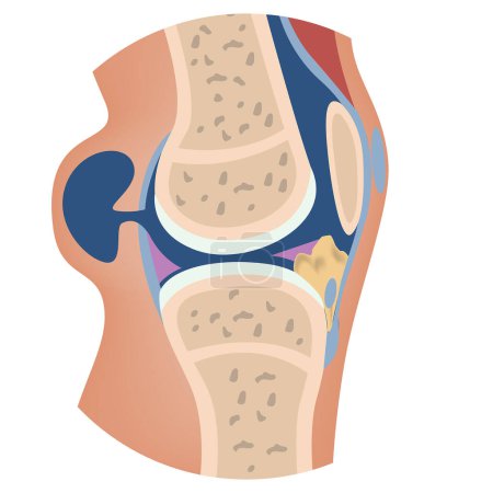 Illustration for Baker's cyst. Anatomy of the knee with damage to the articular capsule and leakage of the synovial substance. Vector illustration - Royalty Free Image