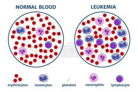Illustration for Leukemia. blood cancer. bodies under the microscope. Medical poster. Vector illustration - Royalty Free Image