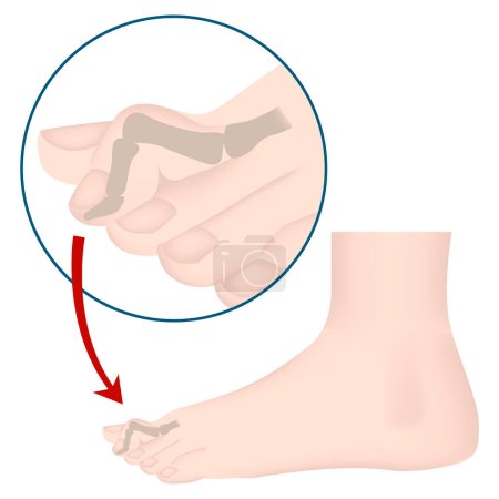 Illustration for Hammer toe deformity. Medical poster. Vector illustration - Royalty Free Image
