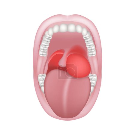 Illustration for Peripharyngeal abscess. Purulent inflammation of the tissue of the peripharyngeal space. Wide open mouth with teeth. Vector illustration - Royalty Free Image