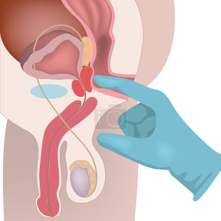 Ilustración de Sistema reproductivo de un hombre. Palpación y masaje de la próstata. Diagrama con órganos internos. Cartel médico. Ilustración vectorial - Imagen libre de derechos