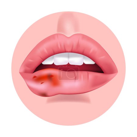 Ilustración de Cáncer de labios. Tumor con sangre. Abre la boca. Ilustración vectorial - Imagen libre de derechos
