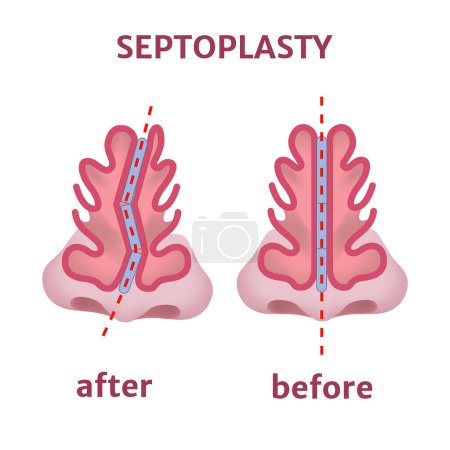 Septoplasty. Nose surgery. Curved cartilage. Medical poster. Vector illustration