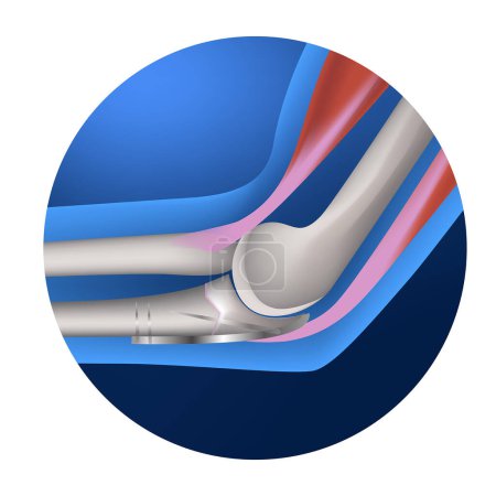 Illustration for Anatomy of the elbow joint. Joint fracture of the arm with metal pins and plates. Surgical intervention. Vector illustration - Royalty Free Image