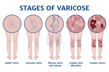 Illustration for Stages of varicose veins. Disease infographic. Medical poster with description. Vector illustration - Royalty Free Image