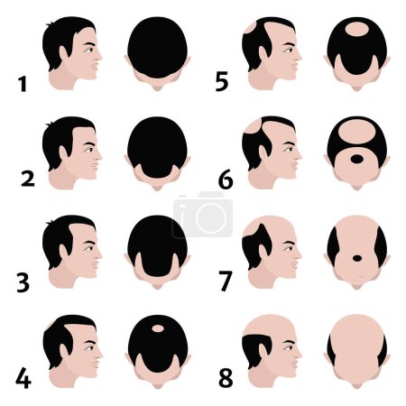 Illustration for Stages of baldness according to the Norwood scale. Vector flat illustration - Royalty Free Image