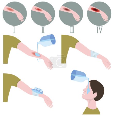 Illustration for Burn stages. First aid for thermal injuries of the body and fires. Medical infographic. Vector illustration - Royalty Free Image