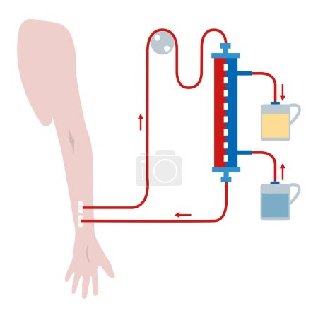 Illustration for Renal hemodialysis scheme. Conditional chart. medical illustration - Royalty Free Image